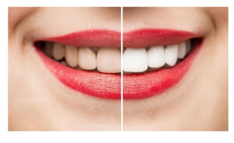 Diş beyazlatma ve yöntemleri