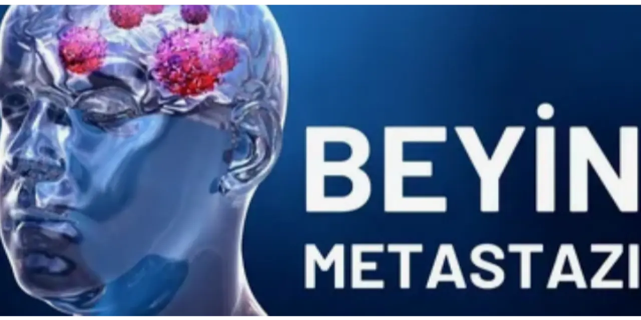 Beyin Metastazı Nedir? Belirtileri ve Tedavi Yöntemleri