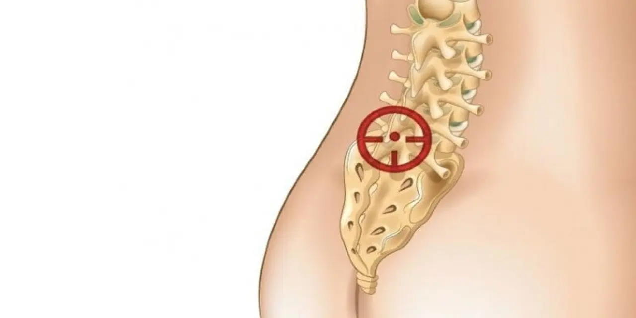 Bel Fıtığı Belirtileri Nedir? Bel Fıtığı Nasıl Geçer?